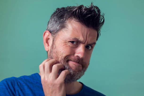 How to prevent and treat beard dandruff? - Menfirst - Dye hair for men